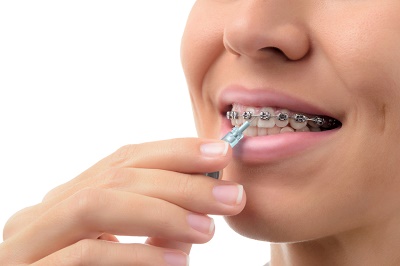 Orthodontie zorgverzekering afsluiten